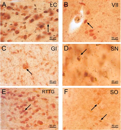 Huntington S Disease Hd The Neuropathology Of A Multisystem