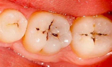 How Can I Remove Stubborn Food Stuck In My Tooth Code Gammy