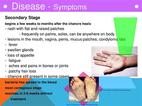 Syphilis Ppt