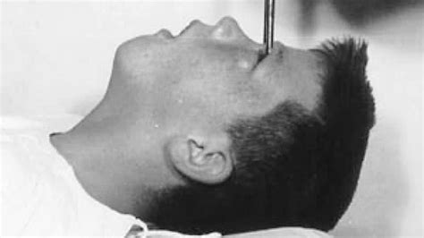 Howard Dully, o garoto que passou por uma brutal lobotomia — e sobreviveu