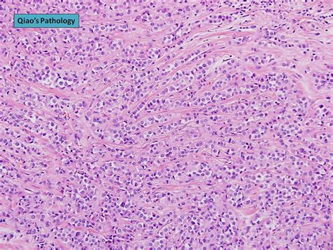 Flickriver Photoset Invasive Lobular Carcinoma With Extracellular