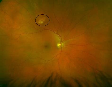 Optos Image Of The Patient S Right Fundus Highlighted Is A White Download Scientific Diagram