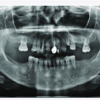 Orthopantomogram Opg Views Shows Filled Endodontically Treated