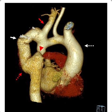 CT Angiography Of Thorasic Aorta 3D Reconstruction Red Arrow The