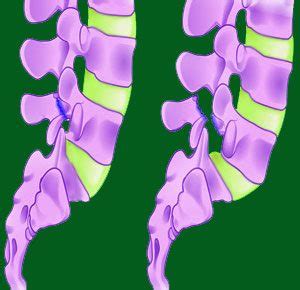 spondylolisthesis-symptoms-14 - Spondylolisthesis