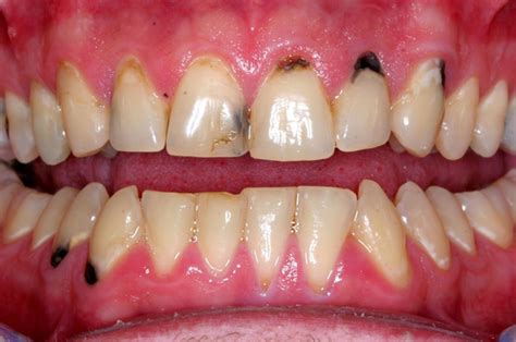 Black Spot On Gums Near Tooth Learn What Causes Dark Spots On Gums