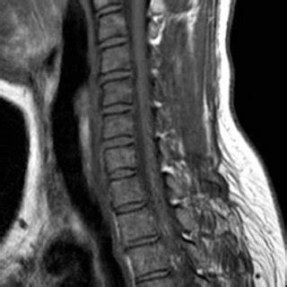 A Sagittal T Weighted Magnetic Resonance Image With Contrast In The