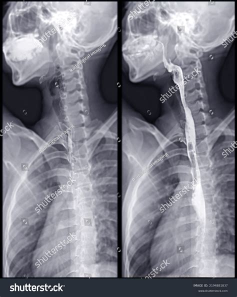 Barium Swallow Study Test Diagnose Barretts Stock Illustration