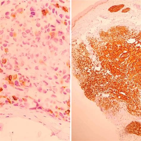 Photomicrograph Showing Immunohistochemistry With Focal Positive HMB45