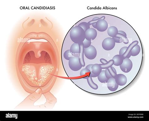 Candidiasis oral fotografías e imágenes de alta resolución Alamy