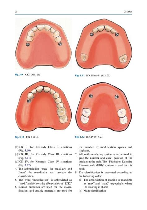 Classification Of Partially Edentulous Space