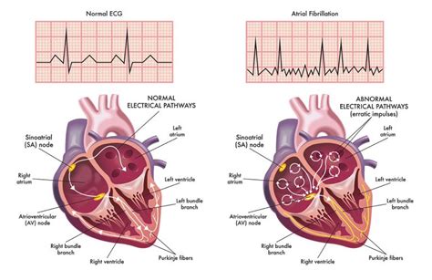 Atrial Fibrillation Ganiyu Oshodi MD Temecula Heart Specialist