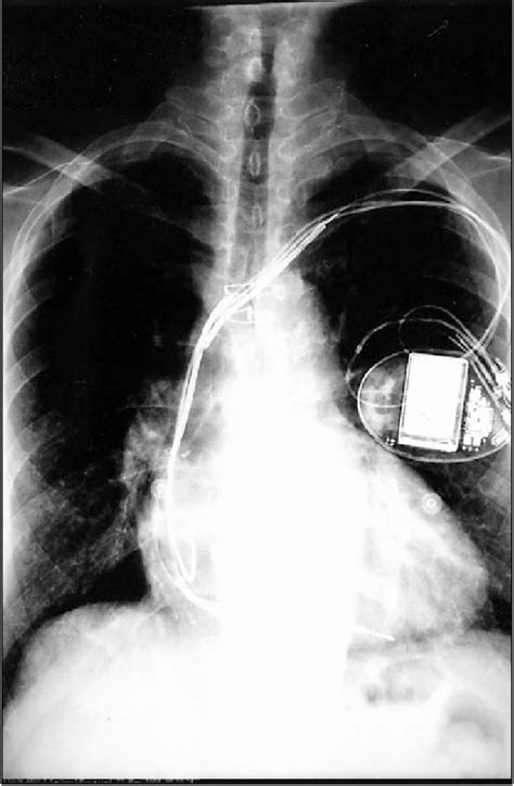 Chest Radiography Showing New Dual Chamber Implantable Download