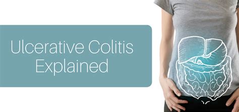 Understanding Ulcerative Colitis Dr Eduan Deetlefs Cape Town