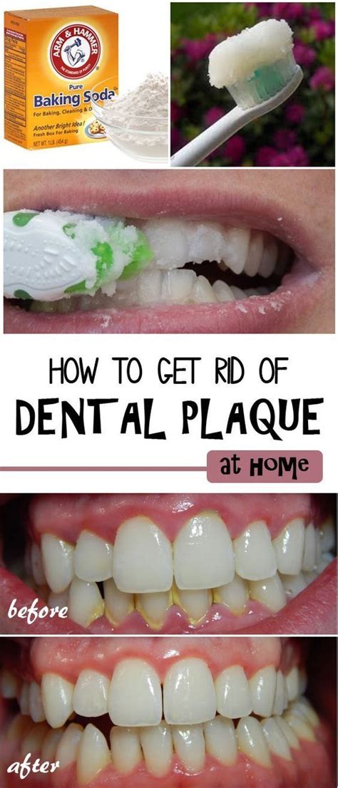 How To Remove Very Hard Plaque From Teeth Howtoremvo