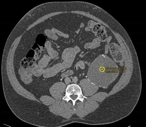 Bosniak 2F Cyst Needs Careful Follow-Up - Kidney Case Studies - CTisus ...