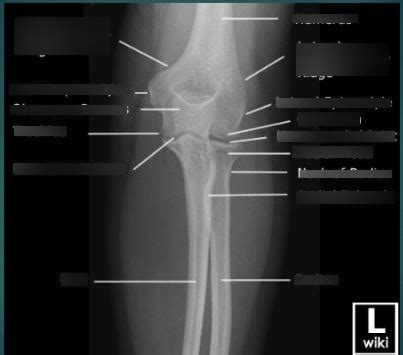 RADANAPHY RADIOGRAPHY OF LEFT ELBOW Diagram Quizlet