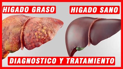 Higado Graso Diagnostico Y Tratamiento Salud De Hoy Youtube