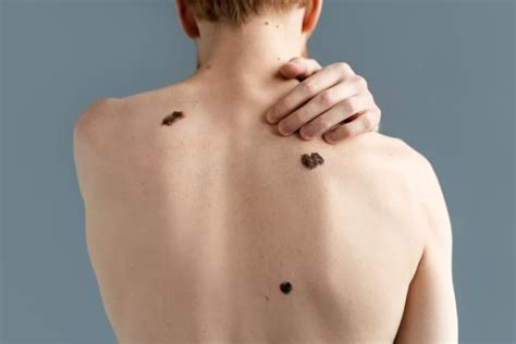 Día Mundial Del Melanoma Por Qué Aumentan Los Casos Quiénes Tienen