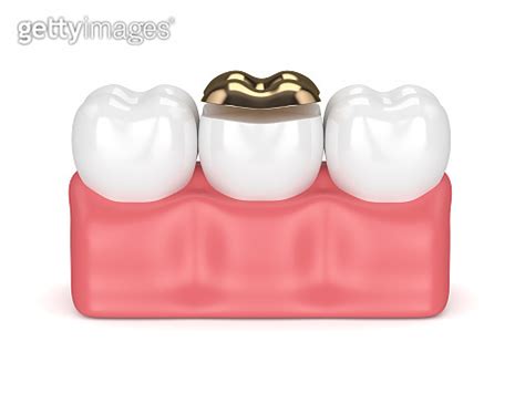 3d render of teeth with dental golden onlay filling 920260548 게티이미지뱅크