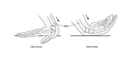 Distal Radius Fractures Broken Wrist Melbourne Hand Therapy