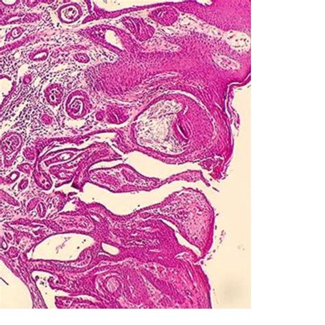 Punch Skin Biopsy From The Lesion The Epidermis Shows Downward