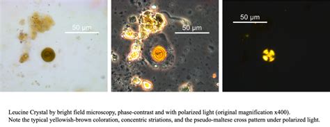 Leucine Crystals in the Urine – Still enigmatic after more than 150 years - Renal Fellow Network