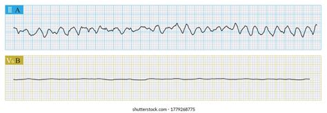 Electrocardiograma Grueso De Fibrilaci N Ventricular