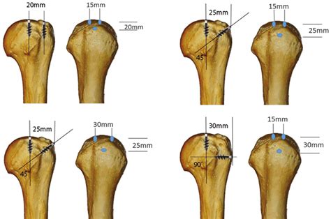 Anchor Positions A Group 1 20 Mm Between Medial And Lateral Row Download Scientific Diagram