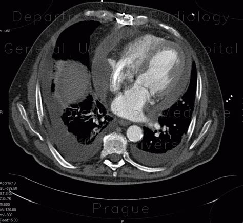 Radiology Case Hemopericardium Perforation Of The Right Atrium