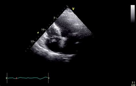 Transthoracic Echocardiogram 4 Days After Admission Apical 4 Chamber