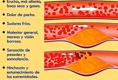 10 Síntomas Del Colesterol Alto Que No Debes Ignorar