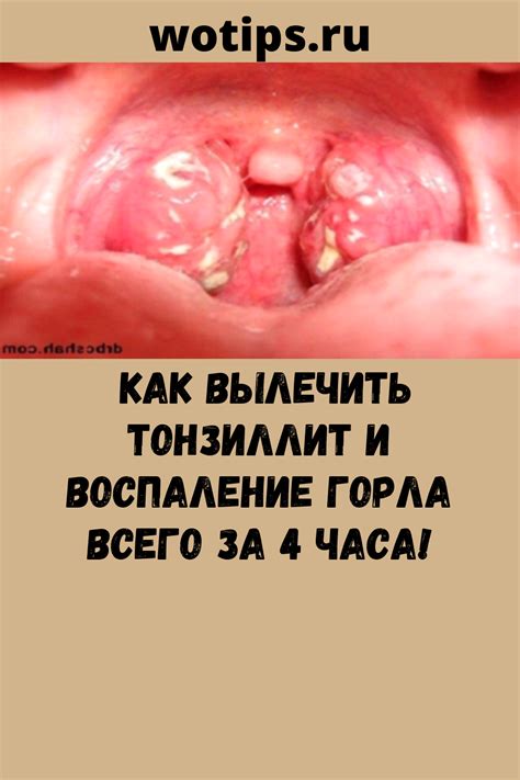 Как вылечить тонзиллит и воспаление горла всего за 4 часа Лечение синусита Альтернативное