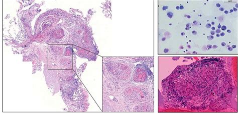 Sarcoidosis Histology