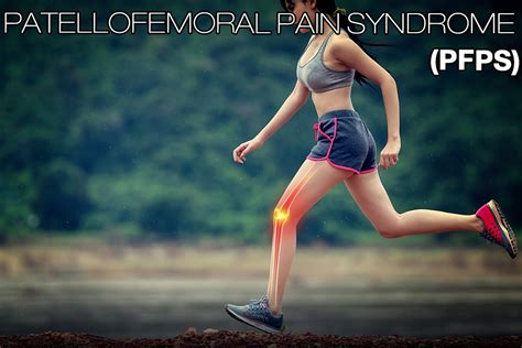 What Is Patellofemoral Pain Syndrome PFPS WorldBrace