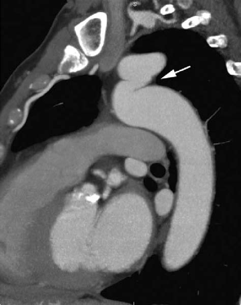 Pseudocoartación de aorta Angio TCMD con reconstrucción sagital y