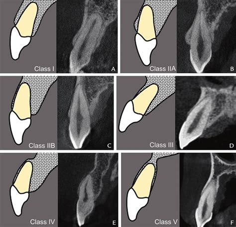 Radial Plane Tooth Root Positions For Maxillary Anterior Teeth A