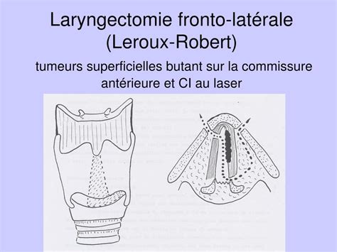 PPT Cancer Du Larynx Et Chirurgie Partielle PowerPoint Presentation