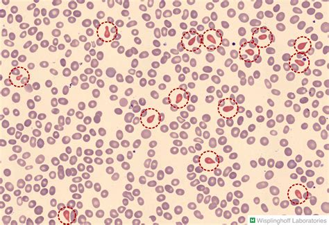 Thalassemia Blood