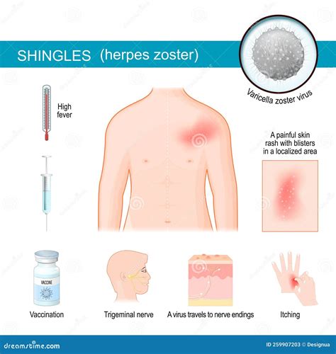 Gürtelrose Infografiken über Symptome Von Herpes Zoster Vektor