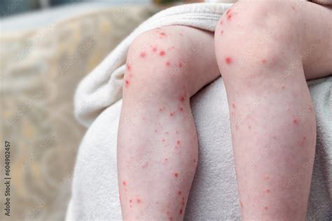 Skin Rash On The Legs Of A Small Child Ulcers From Scratching Acute