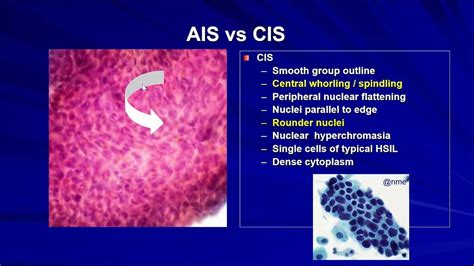 Approach To Glandular Lesions In Cervical Pap Smears Youtube