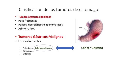 Cáncer Gástrico Generalidades Clínica y Diagnóstico YouTube