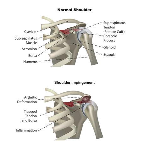 Can Cycling Cause Shoulder Impingement?