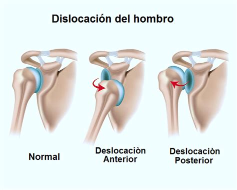 A qué se le llama inestabilidad del hombro Centro Privado Segura