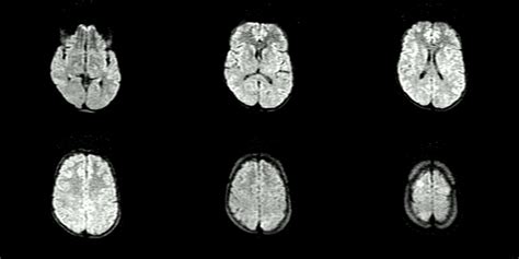 Dr Balaji Anvekar FRCR: Posterior Reversible Encephalopathy MRI