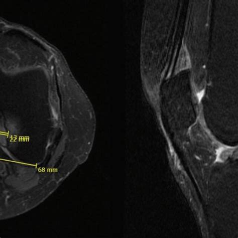 Surgical technique in MDACL. A Mucoid degeneration of ACL in the... | Download Scientific Diagram