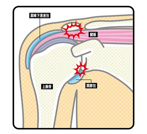 【加齢のトリセツ】四十肩・五十肩を放置してはいけない。別の疾患の可能性も