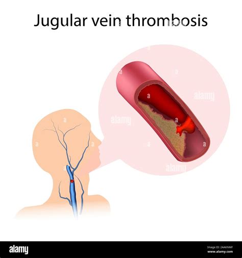 Jugular vein thrombosis, illustration. Blood clot blocking the jugular ...