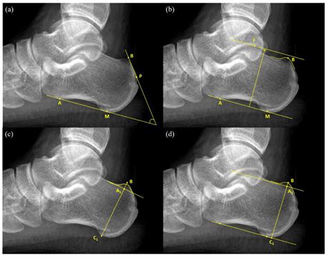 Tomography Free Full Text Novel Radiographic Measurements For Operatively Treated Haglunds